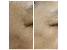 ビーンズ(BEANS)/ララピール