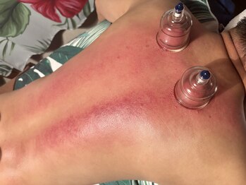 トータルケアサロン アロハオエ(Total care salon Aloha 'Oe)/スライドカッピング