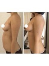 美人バスト 表参道店/【バストアップ/育乳 症例】☆