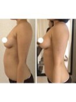 美人バスト 表参道店/【バストアップ/育乳 症例】☆