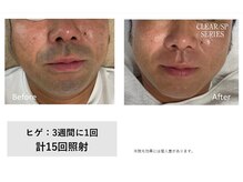 ザ エッセンシャル 碧南(THE Essential)/メンズ　ヒゲ脱毛