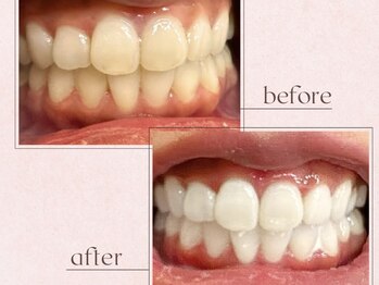 ルアナシンフォニア エクシア 池袋店(Luana-Sinfonia)/ホワイトニングビフォーアフター