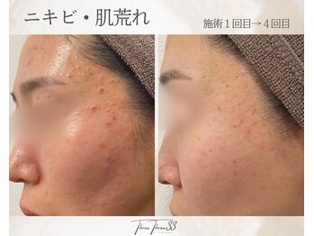 スリースリー(THREE THREE)/ニキビ・肌荒れケア