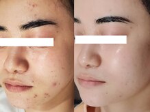 繰り返す肌トラブルへ、根本アプローチを徹底する当店のメニューご紹介