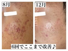 辛い青春ニキビも1日でも早く改善して笑顔に自信持ちましょう！