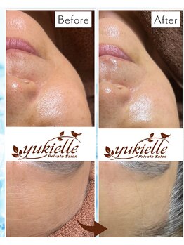 ユキエル(yukielle)/ビフォーアフター