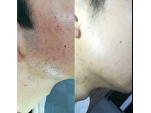 ヘッドサイエンス(HEADSCIENCE)/美容鍼と脱毛で劇的に肌質改善