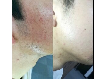 ヘッドサイエンス(HEADSCIENCE)/美容鍼と脱毛で劇的に肌質改善