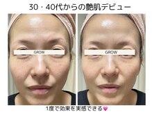 グロウ バイ フェイシャルデザイン アンド アイ(GROW)/クマ・たるみ改善