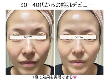グロウ バイ フェイシャルデザイン アンド アイ(GROW)/クマ・たるみ改善