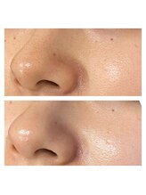 ボンズ(bonds.)/徹底毛穴洗浄！つやつや鼻に☆