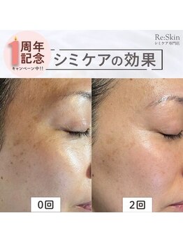 リスキン(Re:Skin)/