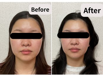 ブプラ 池田店(BUPURA)/小顔 毛穴 開き 肌質改善 