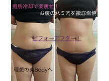 ルフレ/脂肪冷却8カップ