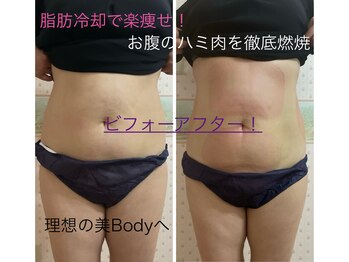 ルフレ/脂肪冷却8カップ