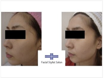 フェイシャルスタイリストサロン 四谷店/ケア例(32)