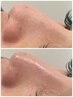 【いちご鼻吸引×毛穴引き締め】毛穴美人コース×光フェイシャルor顔脱毛