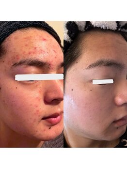 ウイユ(Oeil)/剥けるハーブピーリング 効果4回