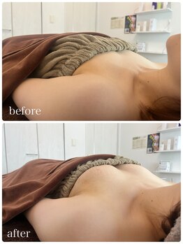 リノ 行橋(lino)/◇バストアップ症例◇30代