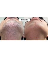 キザシ(kizashi)/髭脱毛は当たり前の時代？