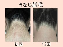 ウィズマツオカ 菊池本店/うなじ脱毛