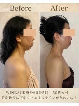 エソール(essor)/フェイスラインすっきり