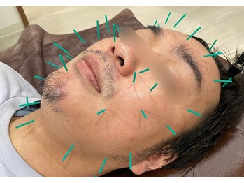 はりきゅう漫々/美容鍼