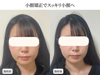 ドリームスパ 武蔵小杉店(DREAM SPA)/小顔before→after