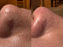 サラグランデ(Sara Grande)/メンズ毛穴エクストラクション