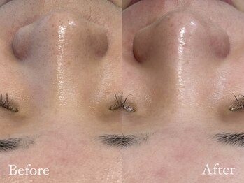 ファミーユ 太田(Fameu)/毛穴洗浄&フェイシャルワックス