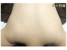 ピリナ 名古屋/【背中ハーブピーリング】症例