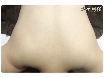 ピリナ 名古屋/【背中ハーブピーリング】症例