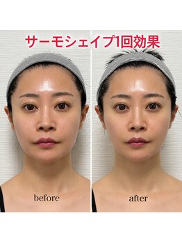 フェムプリュ(femplus)の写真/【小顔人気No.1】高周波でキュッと引き締め♪『サーモシェイプopas』二重顎/シワ/たるみ即改善