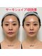 フェムプリュ(femplus)の写真/【小顔人気No.1】高周波でキュッと引き締め♪『サーモシェイプopas』二重顎/シワ/たるみ即改善