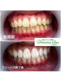 ホワイトニングサロン 名古屋駅店/【ホワイトニング施術例】