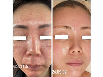 ルオント(LUONTO)/何をしてもダメだった肌が