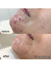 ブリス(Bliss)/部分改善