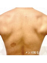 ナムズ(Nams)/全身脱毛（顔VIO込み)