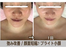 アルページュ(Arpege)の雰囲気（チタニウムでエイジング♪シミ肌ムラ◎ギュッと輪郭♪顔面短縮へ）