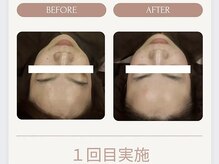 美々庵/光フェイシャル◆