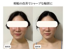 ドリームスパ 武蔵小杉店(DREAM SPA)/小顔before→after