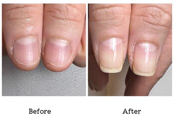 アンベリール(embellir.)/自爪育成/深爪育成