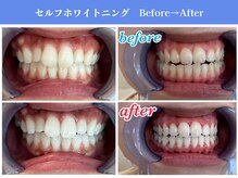 エクシアホワイトニング 岡崎店/白い歯で笑顔に★ホワイトニング