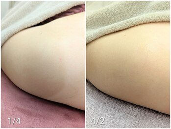 ラミーユ(La Miu)/両肩ハーブピーリング５回