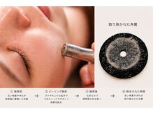 全国3000店舗の頂点へ！劇的な改善結果を認められた福岡唯一のダイヤモンドサロンの限定ケア。