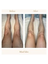 ミセル ラボ(Misel Labo)/before after