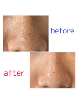 姿勢矯正院 屋代店/毛穴の汚れすっきりー！