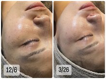 ベルーチェ(Beluce)/シミケアしながら、肌質も綺麗に