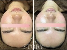 ストーリー 岐阜店(STORY)/ハーブピーリング専門店STORY