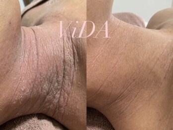 ヴィーダ 渋谷松濤(ViDA)/REVI剥けない首ハーブピーリング